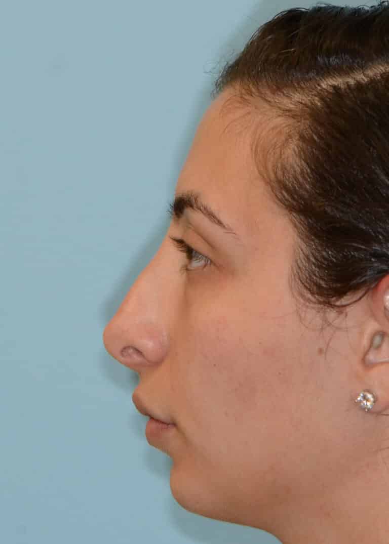 Before Image:  - left-side