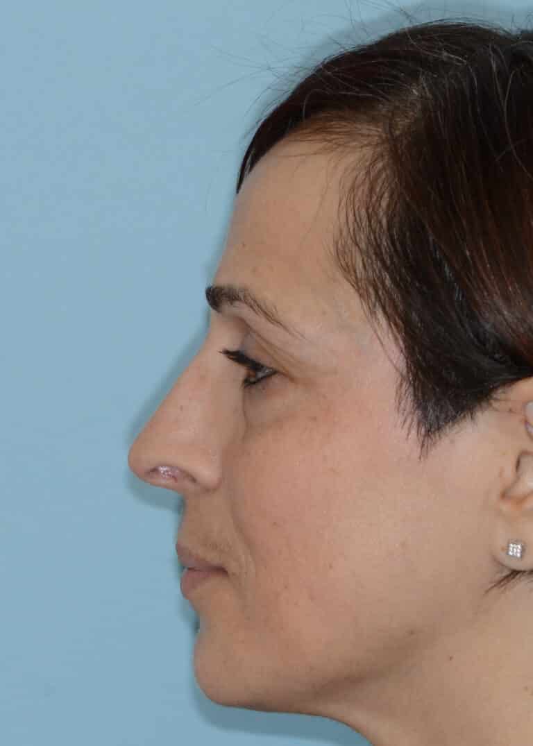 After Image:  - left-side